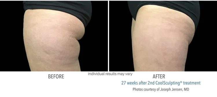 CoolSculpting Banana Roll: An Effective Solution for Stubborn Fat Deposits
